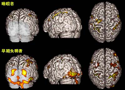 視覚障害者の点字弁別課題における両側一次視覚野の脳賦活