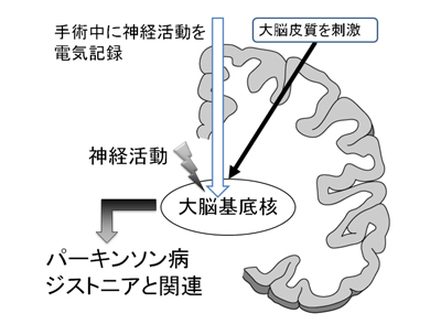 パーキンソン図１.jpg