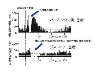 パーキンソン図２.jpg