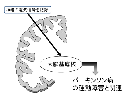 パーキンソン１.jpg