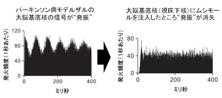 パーキンソン３.jpg