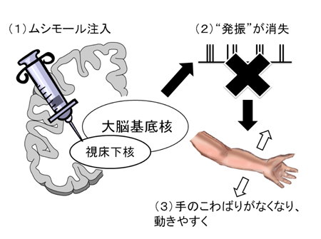 パーキンソン５.jpg